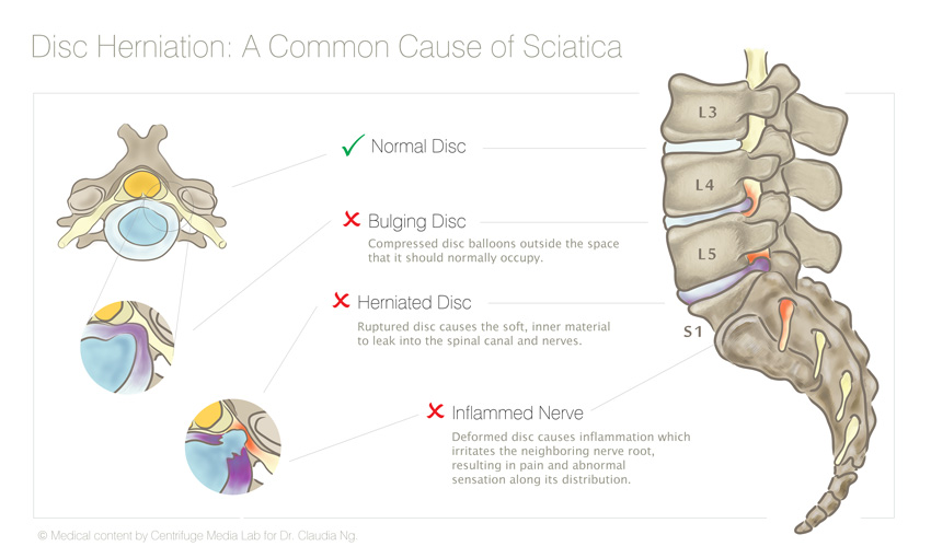 Disc Herniation: A Common Cause of Sciatica